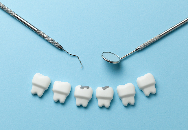 むし歯の模型のイメージ