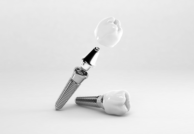 インプラントのイメージ