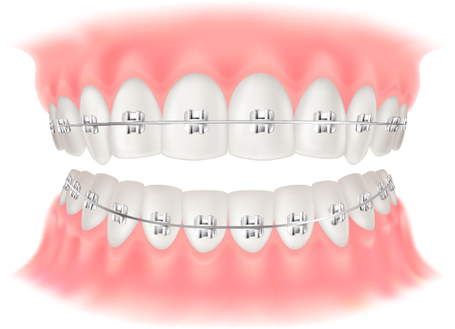 ワイヤー矯正（当医院ではワイヤー矯正は行っていません）